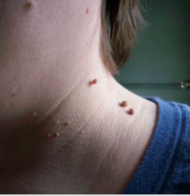 Woman With Skin Tags