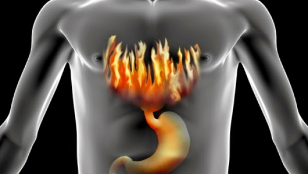 Preventing and Relieving Acid Reflux | Health