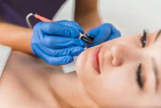 Electrolysis Laser Hair Removal in Dubai