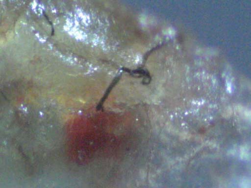 Morgellons Disease: Real Infection or Delusion? (Videos)