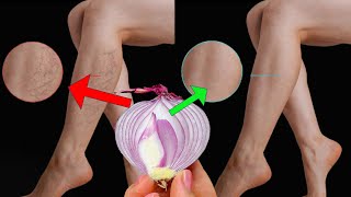 unbelievable  varicose veins are silent killers erase them like an eraser with 2 recipes  diy